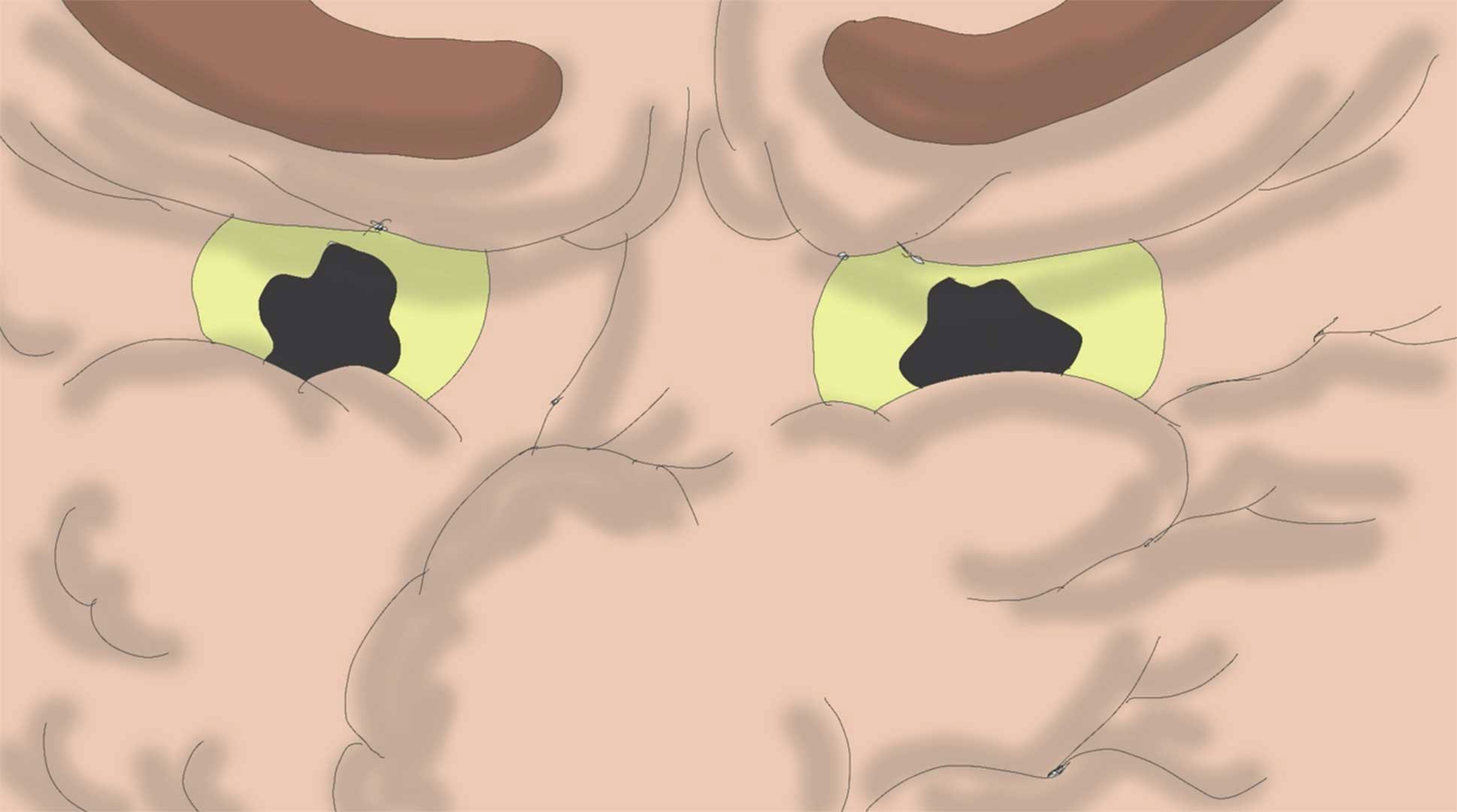 „displaced love“ - soft maximum